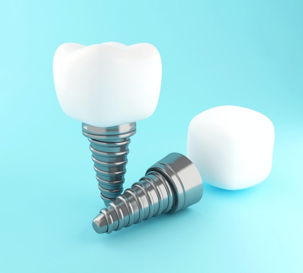 3d Dental tooth implant.